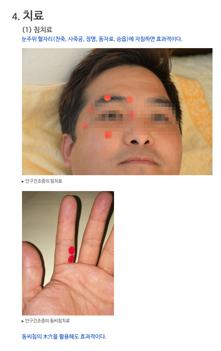 안구건조증치료