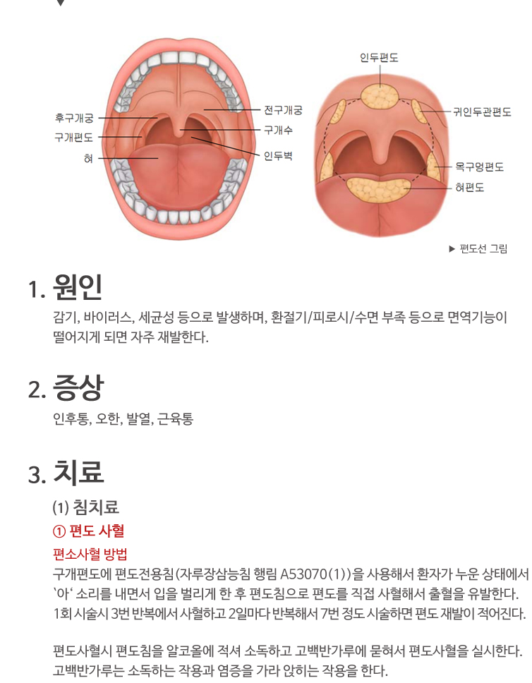 편도선염증상