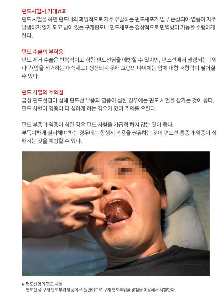편도선염치료